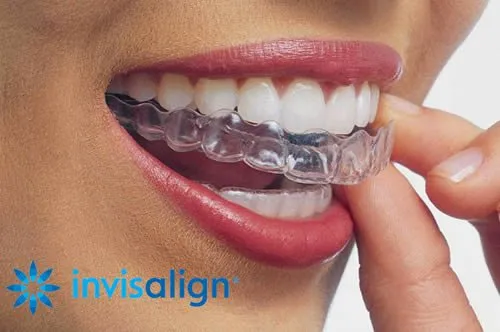 Paciente colocándose un alineador transparente Invisalign