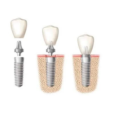Implante dental, pilar y corona: las tres partes que reemplazan un diente perdido